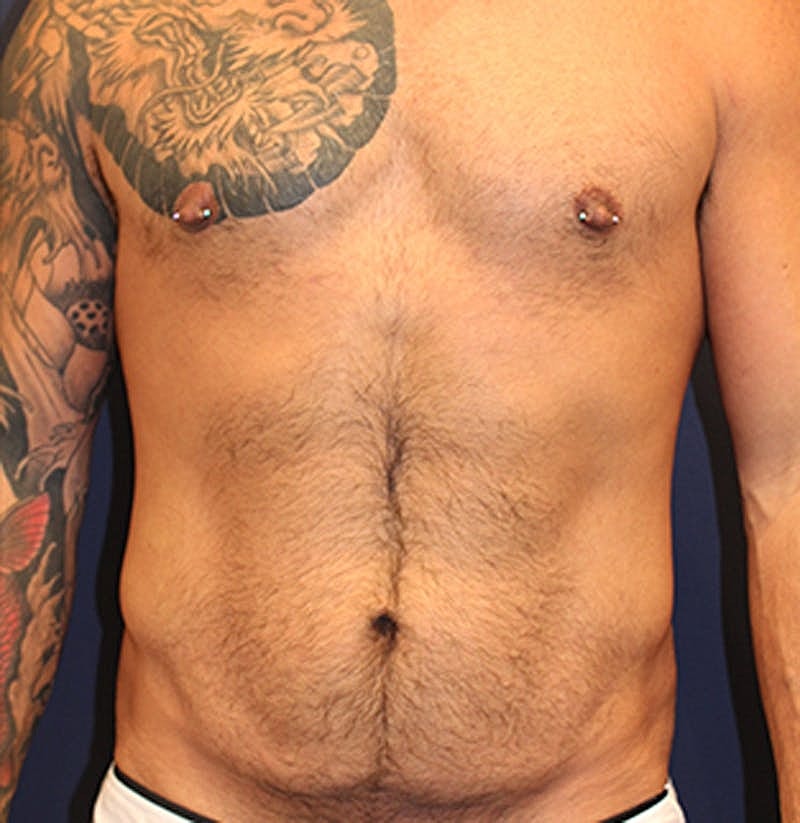 Massive Weight Loss Before & After