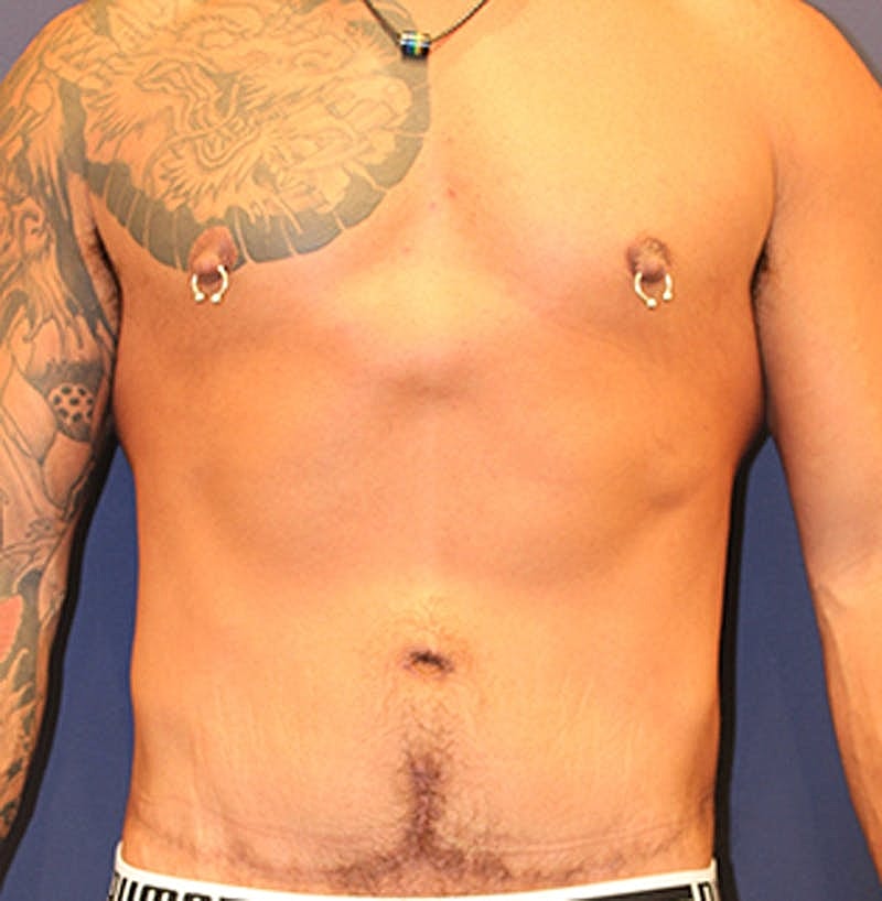 Massive Weight Loss Before & After