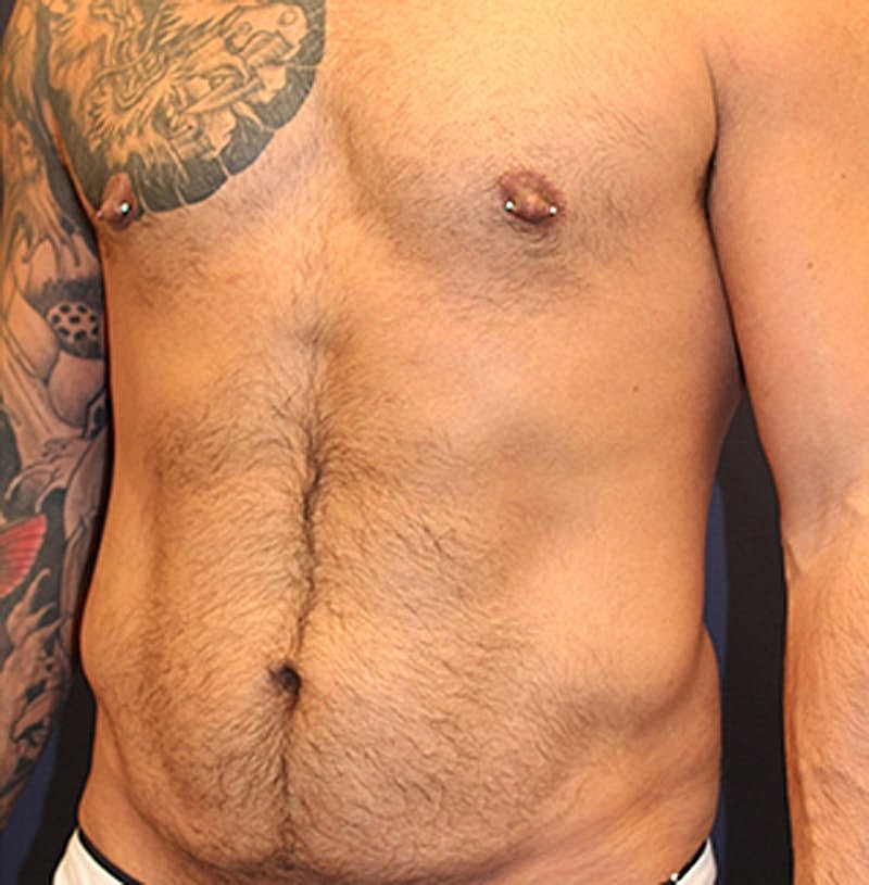 Massive Weight Loss Before & After