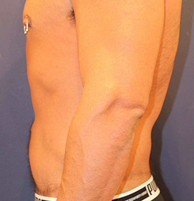 Massive Weight Loss Before & After