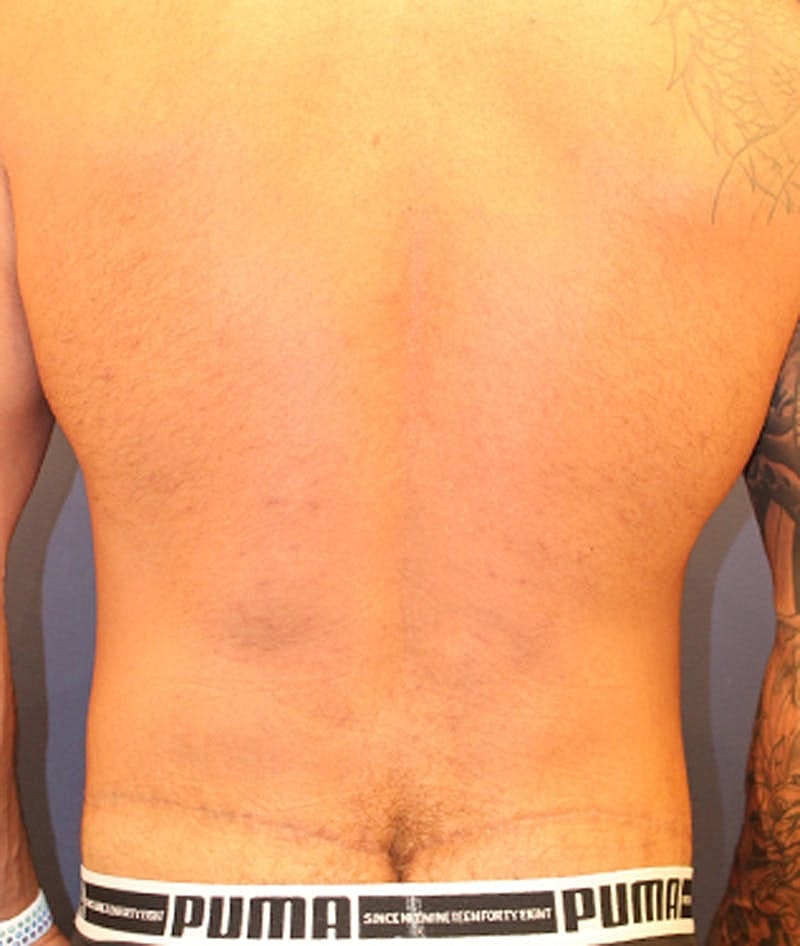 Massive Weight Loss Before & After