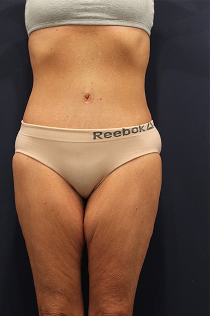 Massive Weight Loss Before & After