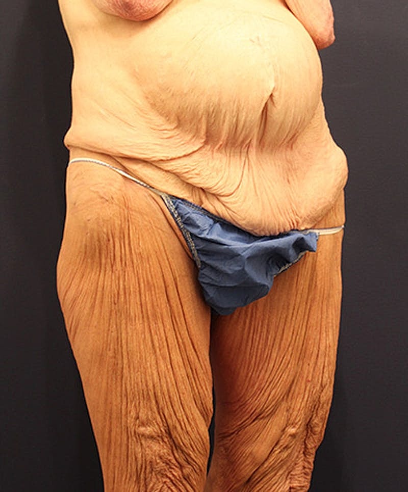 Massive Weight Loss Before & After