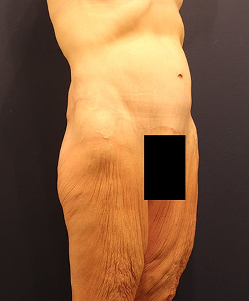 Massive Weight Loss Before & After