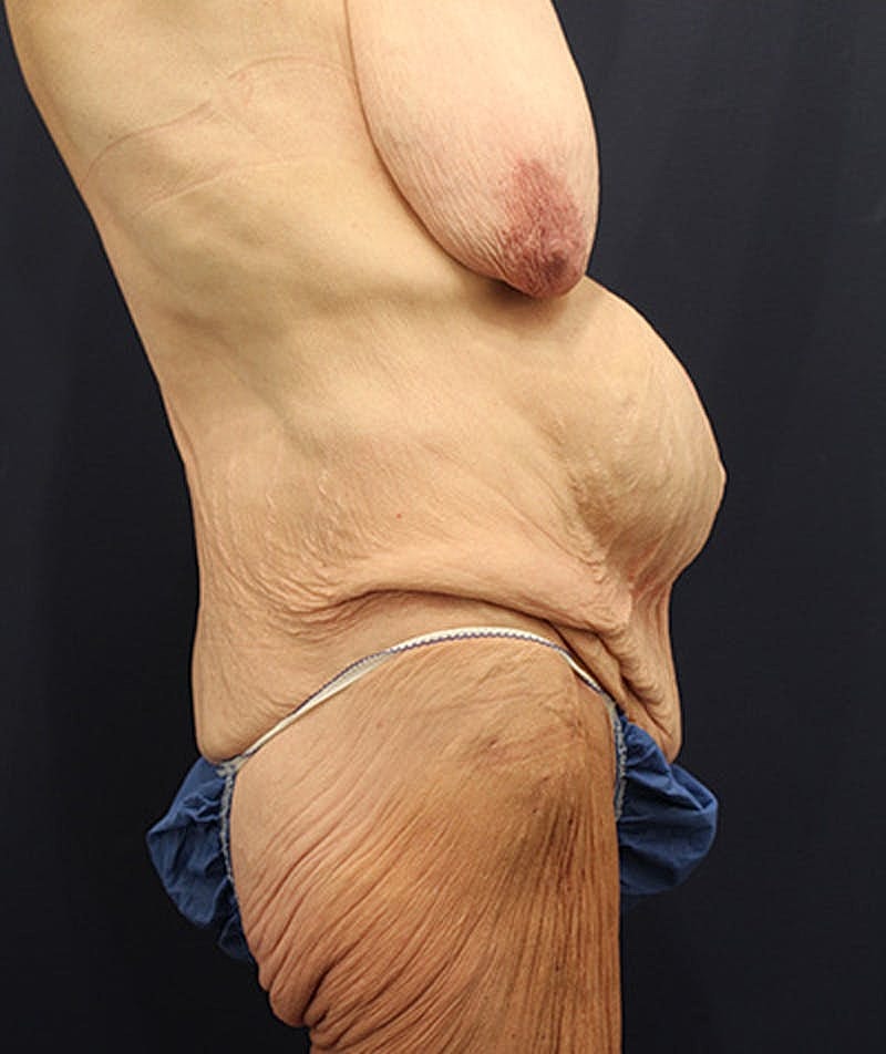 Massive Weight Loss Before & After