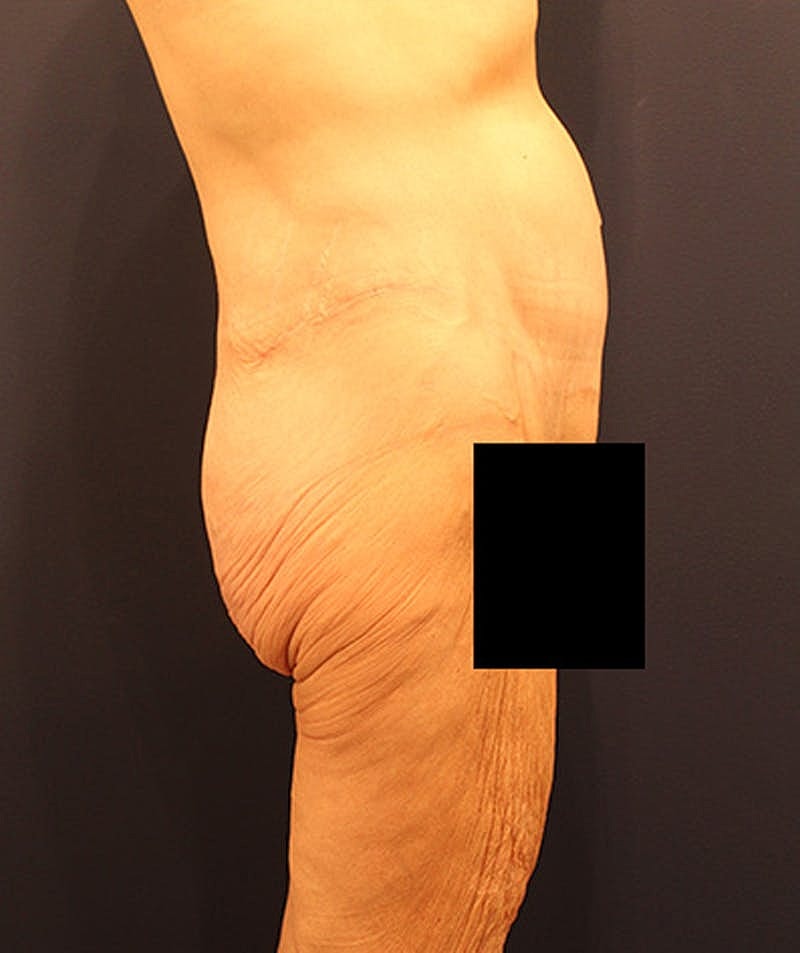 Massive Weight Loss Before & After