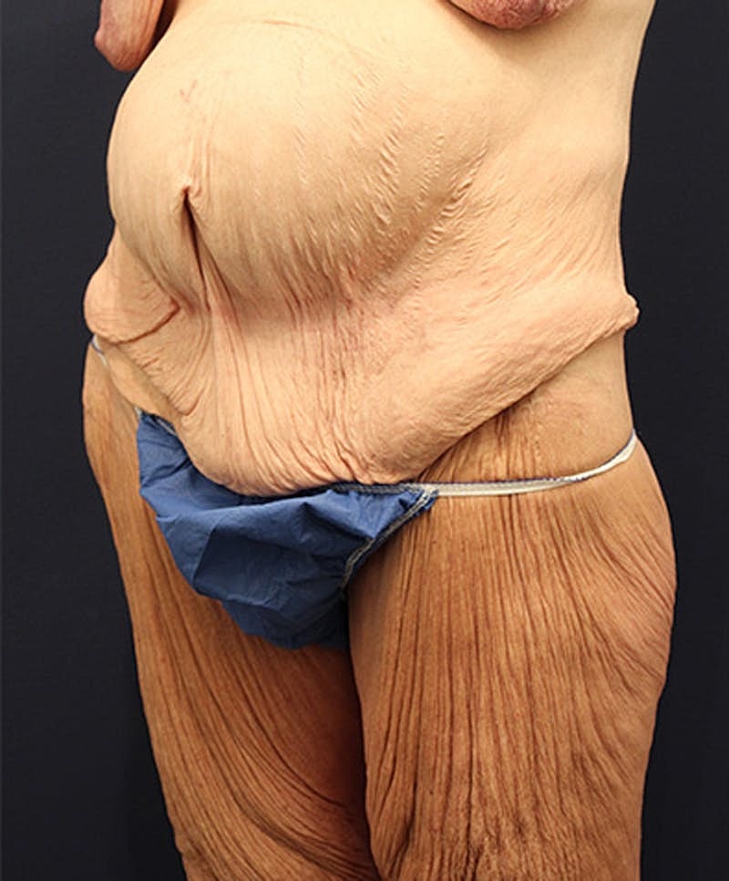 Massive Weight Loss Before & After