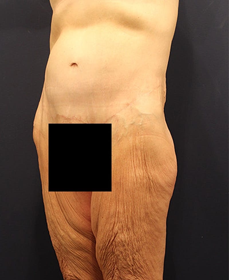 Massive Weight Loss Before & After