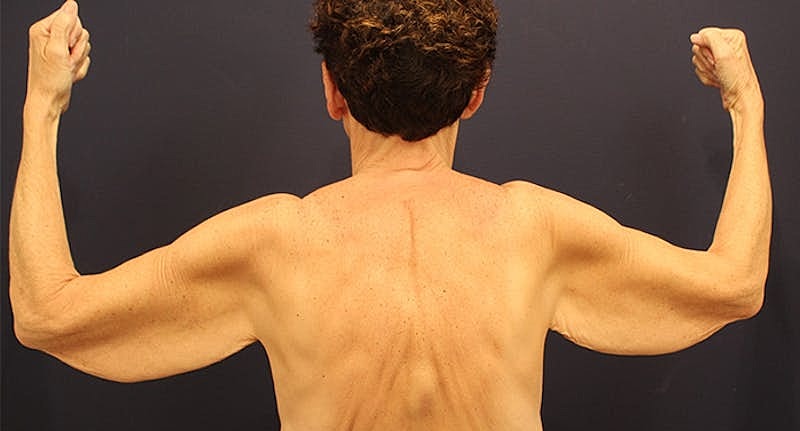 Massive Weight Loss Before & After