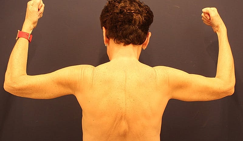 Massive Weight Loss Before & After