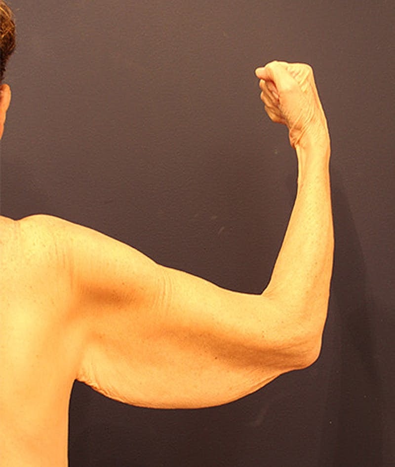 Massive Weight Loss Before & After