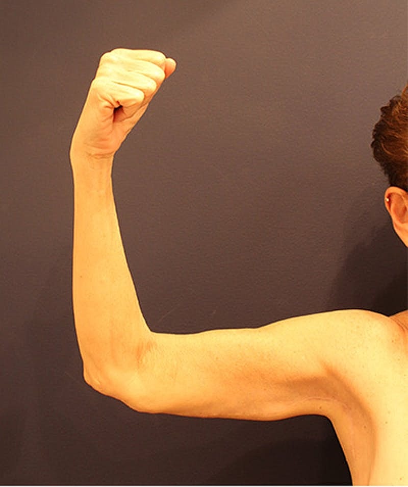 Massive Weight Loss Before & After