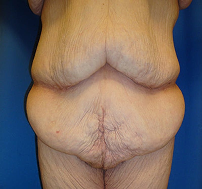 Massive Weight Loss Before & After