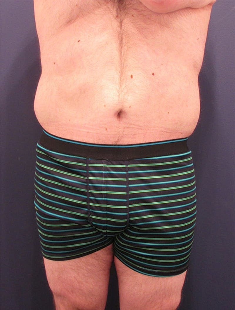 Massive Weight Loss Before & After