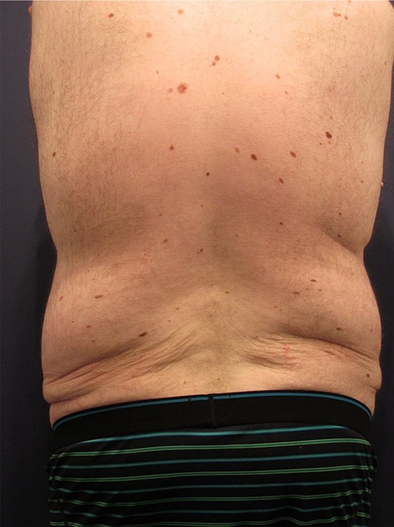 Massive Weight Loss Before & After