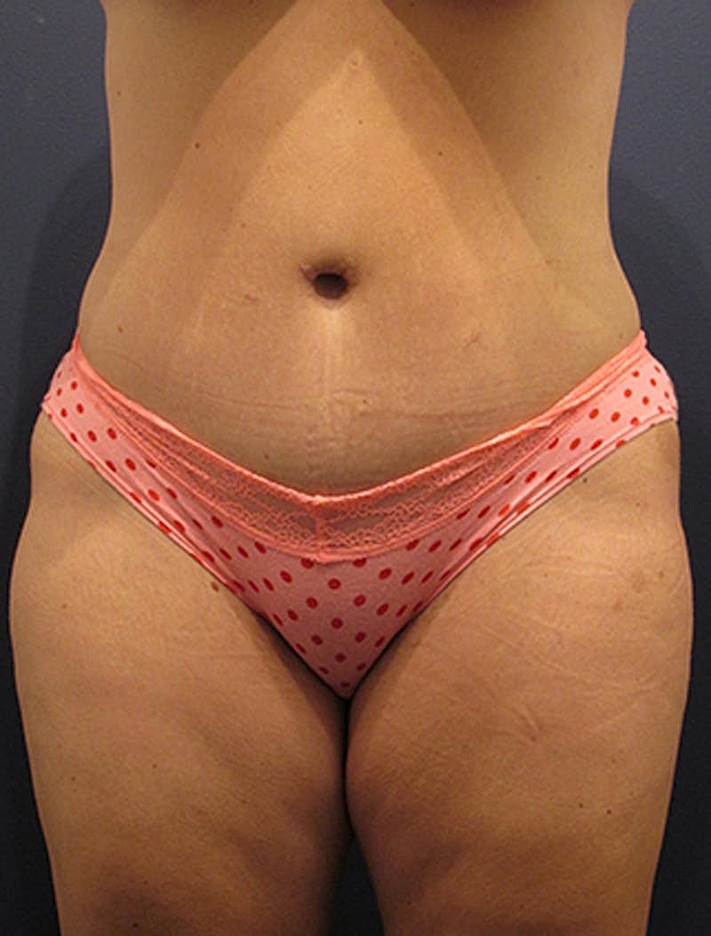 Massive Weight Loss Before & After