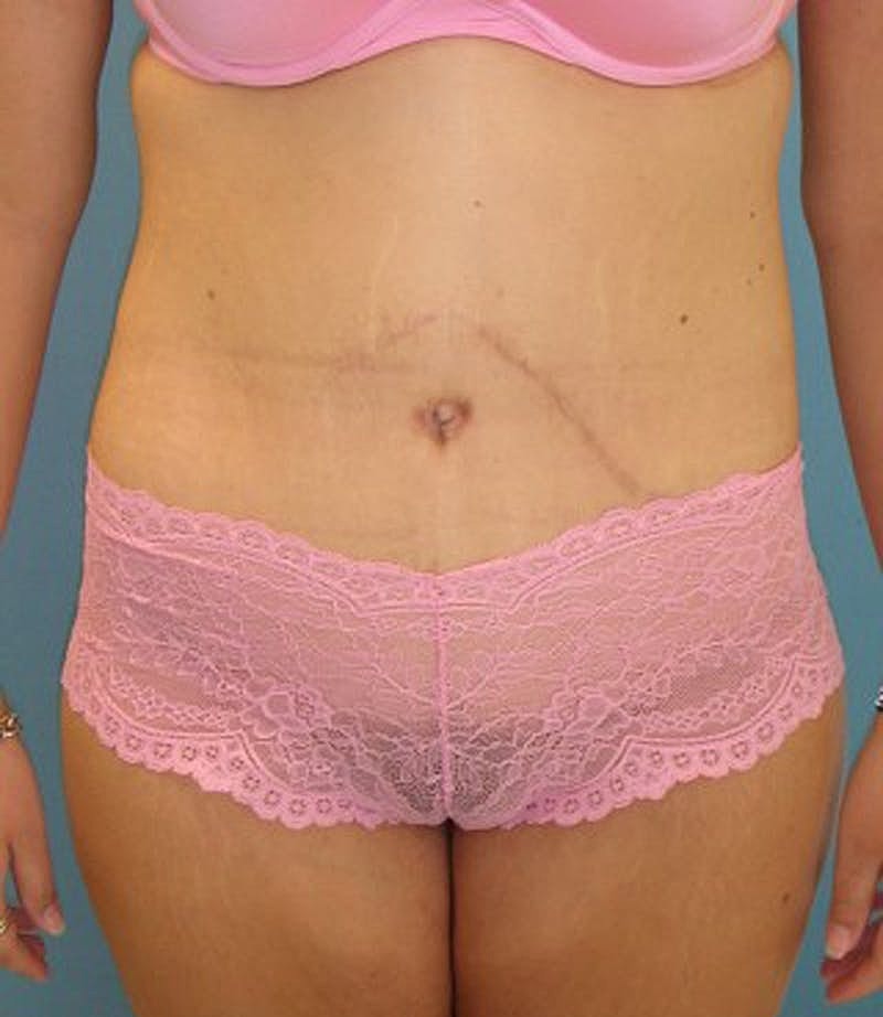 Massive Weight Loss Before & After