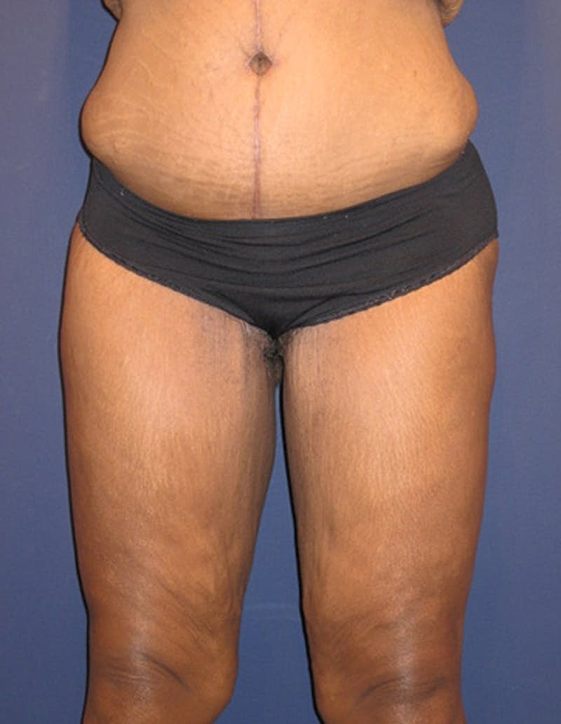 Massive Weight Loss Before & After