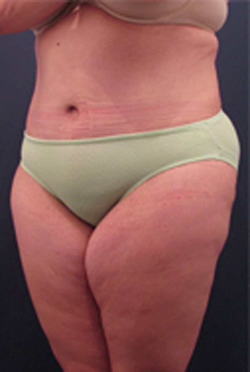 Massive Weight Loss Before & After