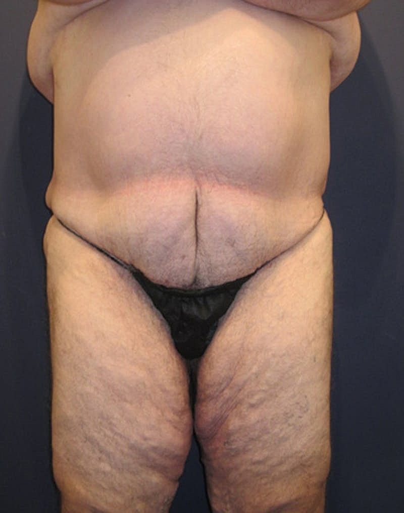 Massive Weight Loss Before & After