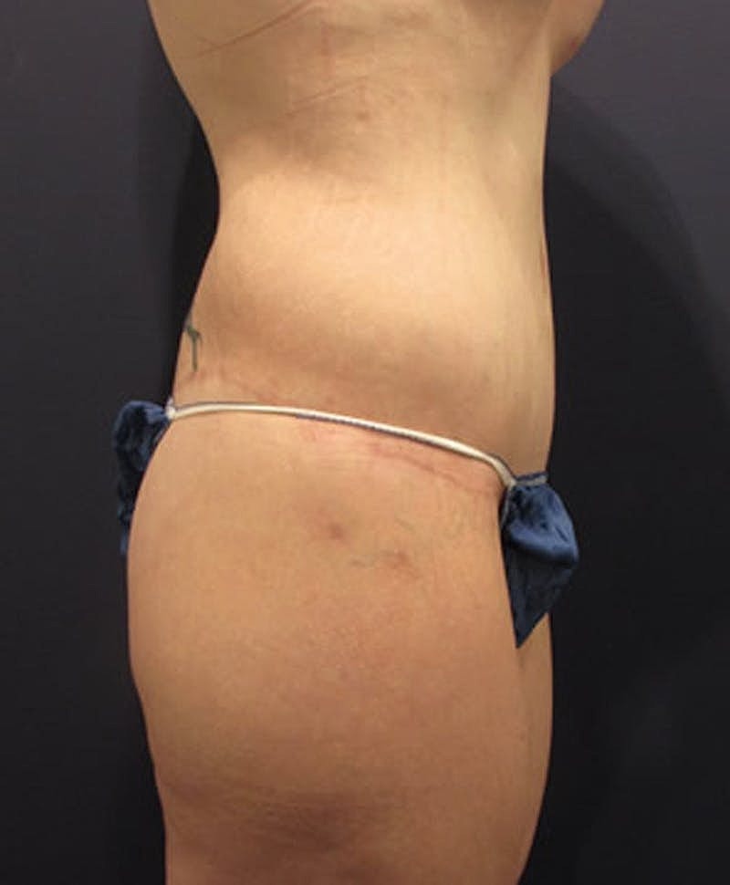 Massive Weight Loss Before & After