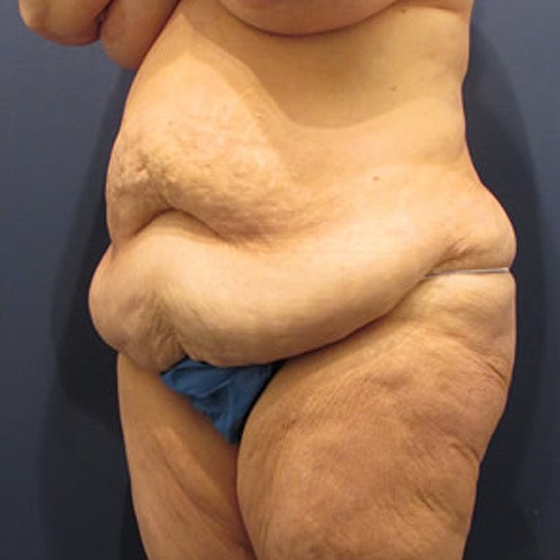 Massive Weight Loss Before & After