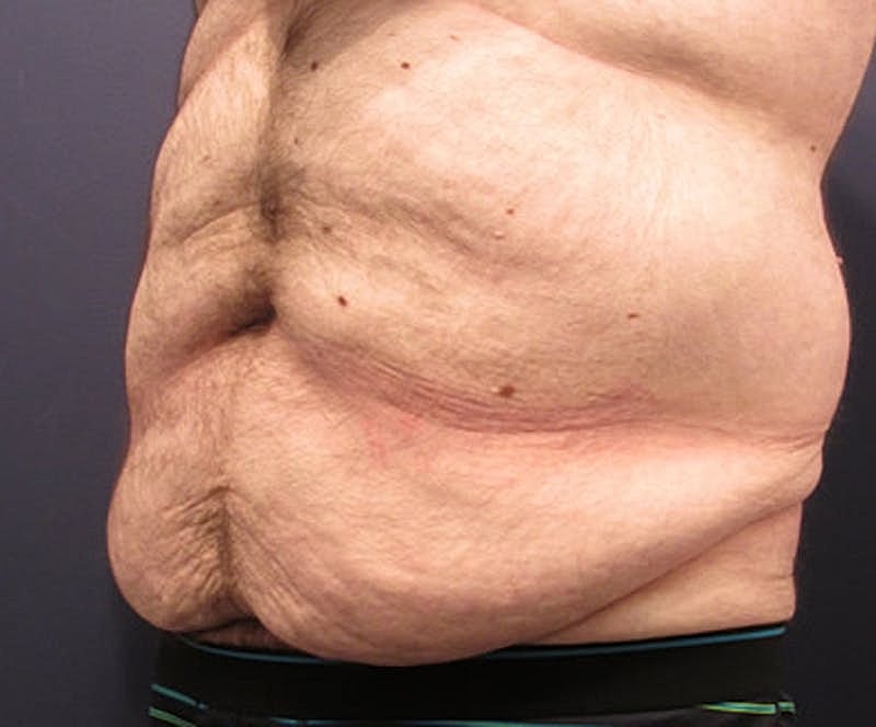 Massive Weight Loss Before & After