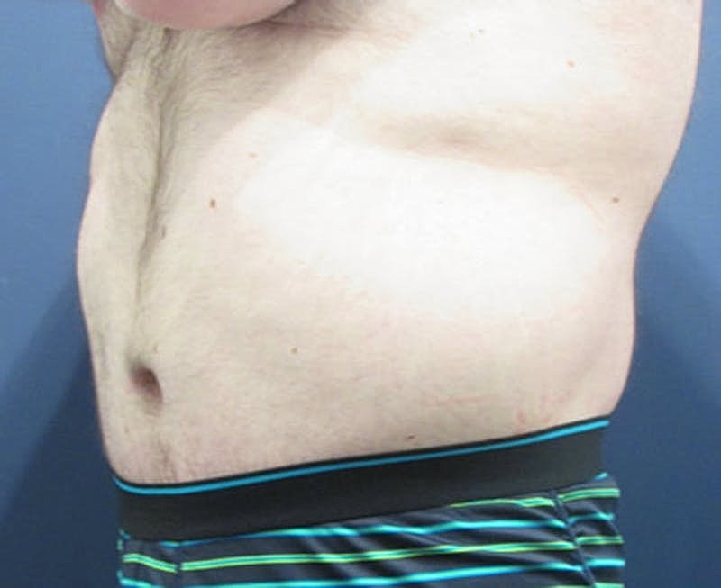 Massive Weight Loss Before & After