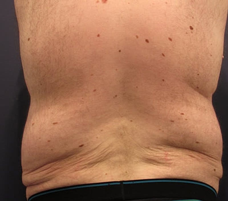 Massive Weight Loss Before & After