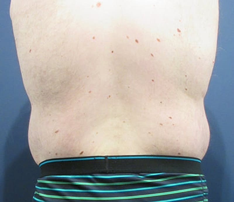 Massive Weight Loss Before & After