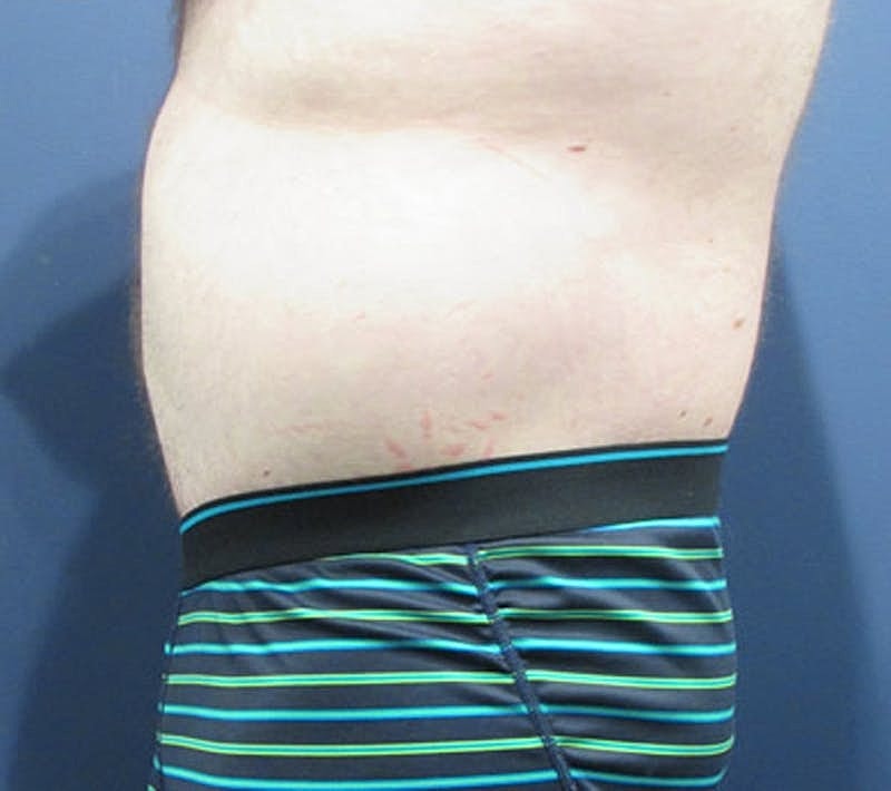 Massive Weight Loss Before & After