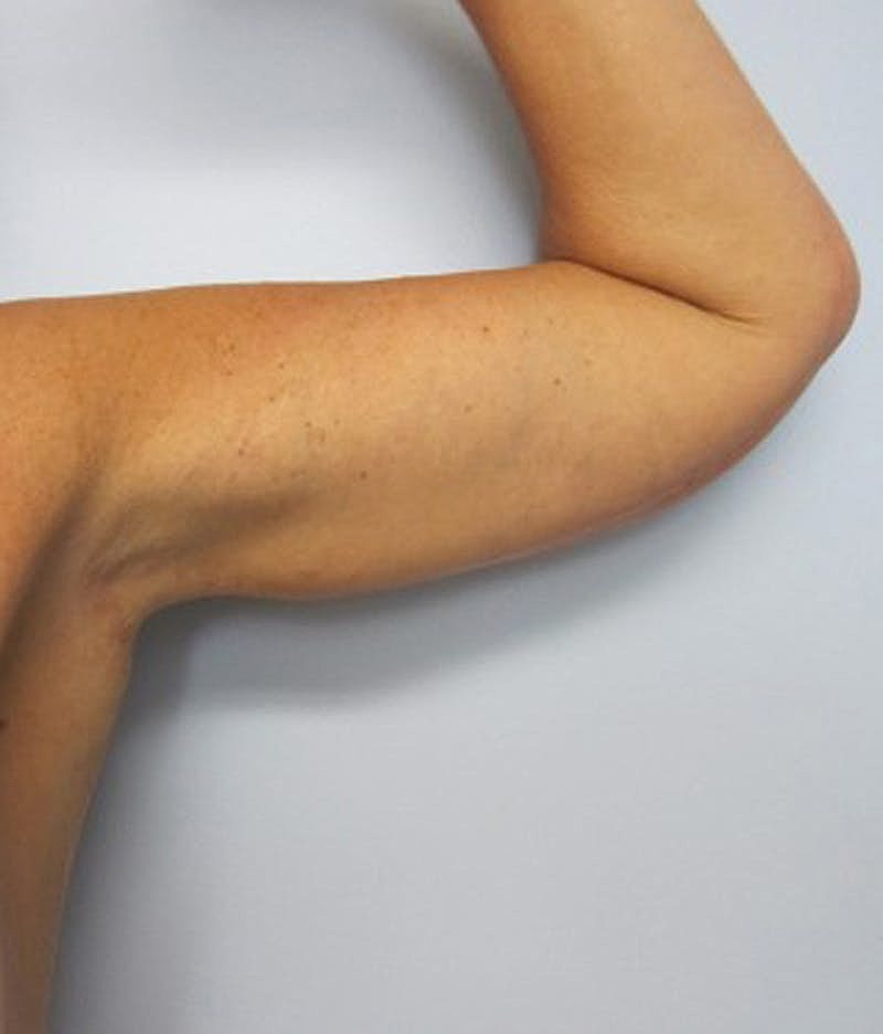 Massive Weight Loss Before & After