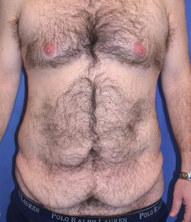 Massive Weight Loss Before & After