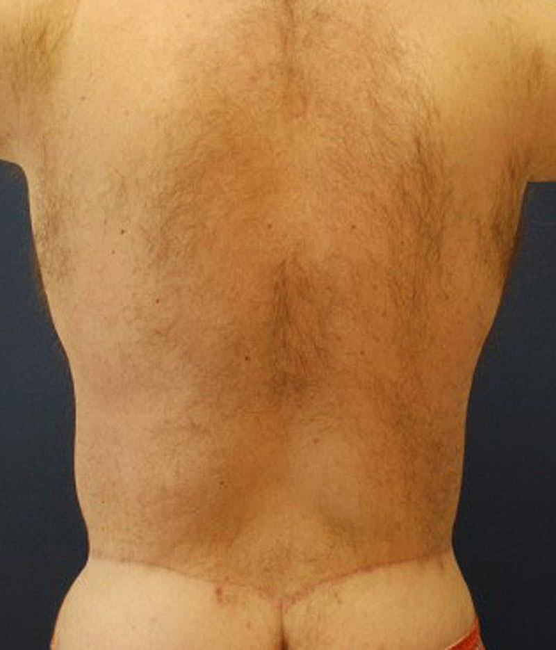 Massive Weight Loss Before & After