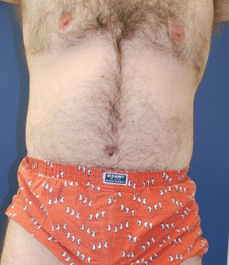 Massive Weight Loss Before & After