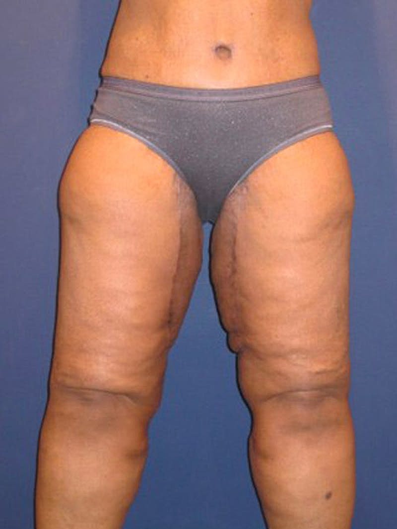 Massive Weight Loss Before & After