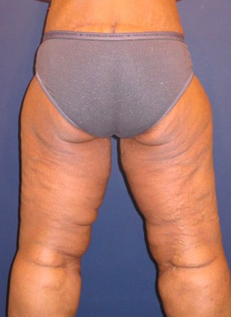 Massive Weight Loss Before & After