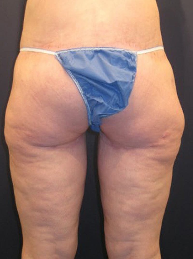 Massive Weight Loss Before & After