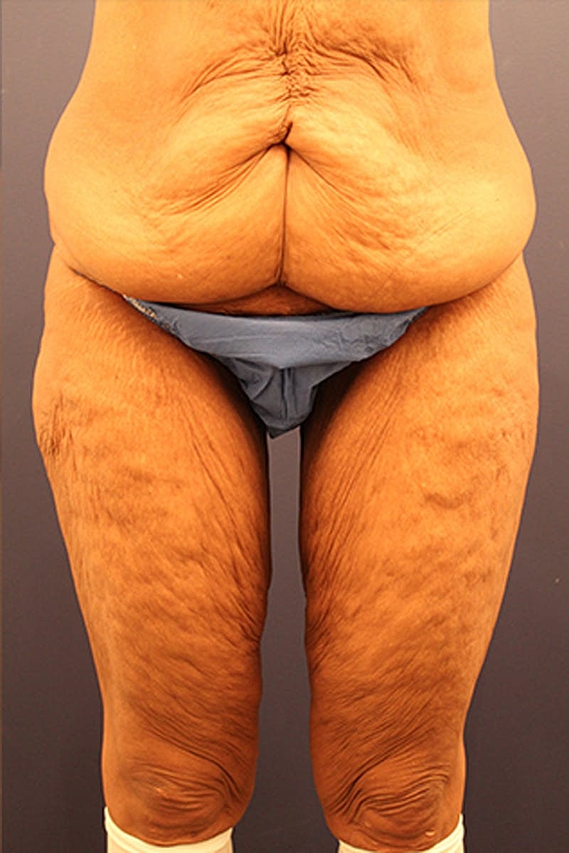 Massive Weight Loss Before & After