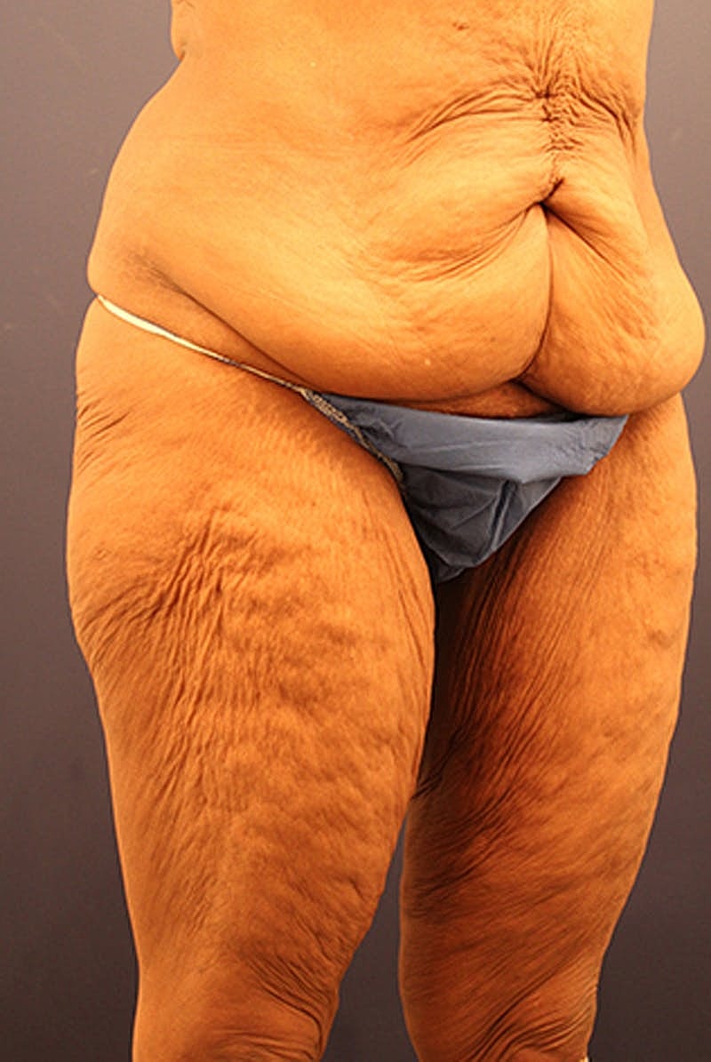 Massive Weight Loss Before & After