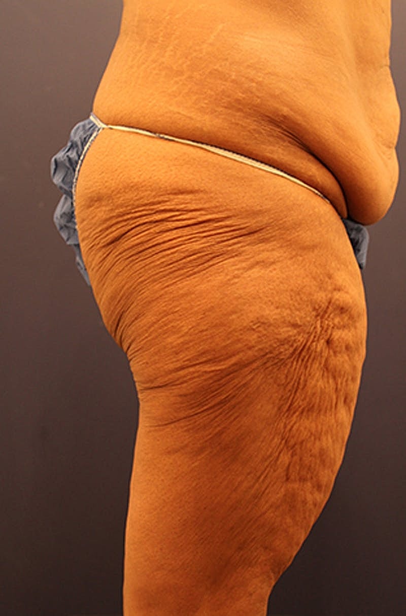 Massive Weight Loss Before & After