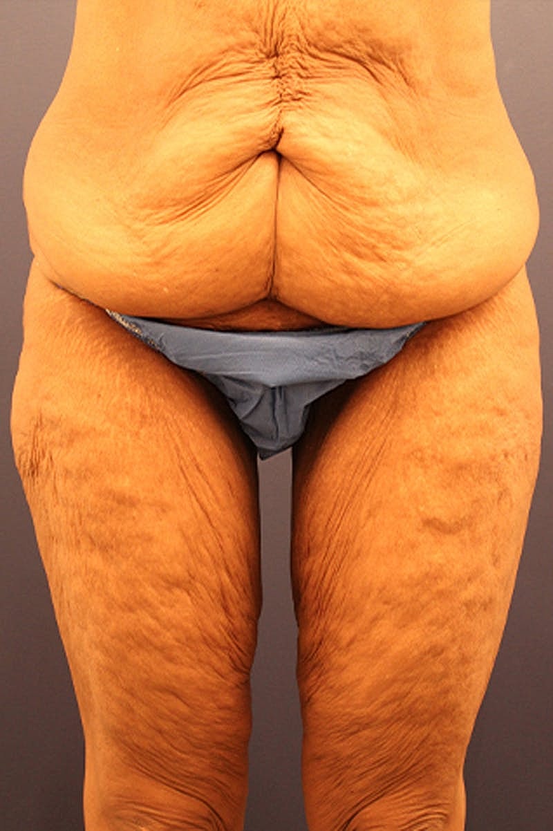 Massive Weight Loss Before & After