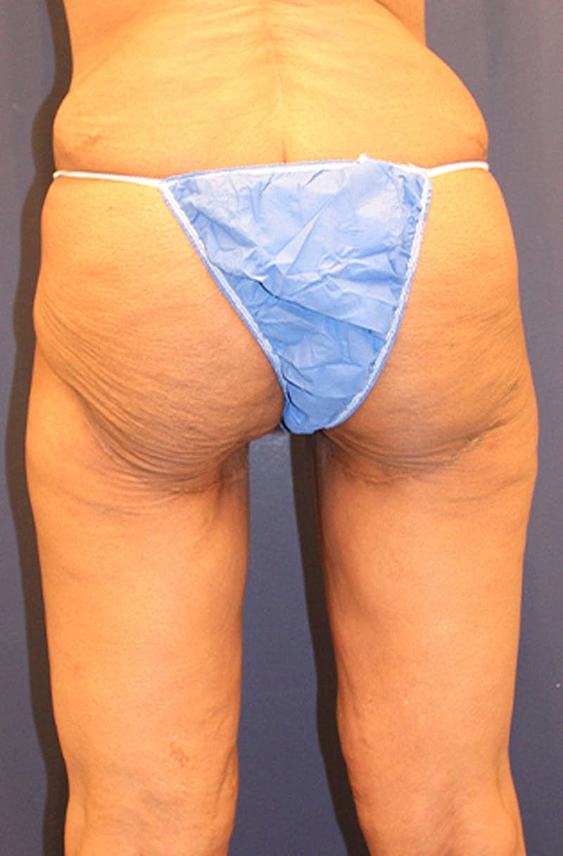 Massive Weight Loss Before & After