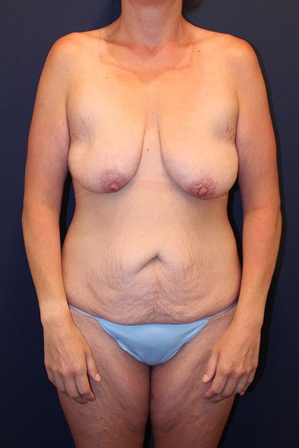Massive Weight Loss Gallery Before & After