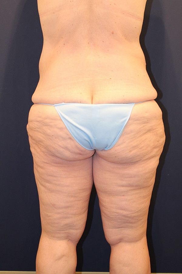 Massive Weight Loss Gallery Before & After