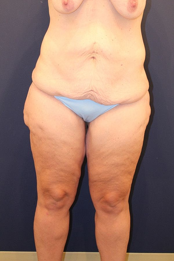 Massive Weight Loss Gallery Before & After
