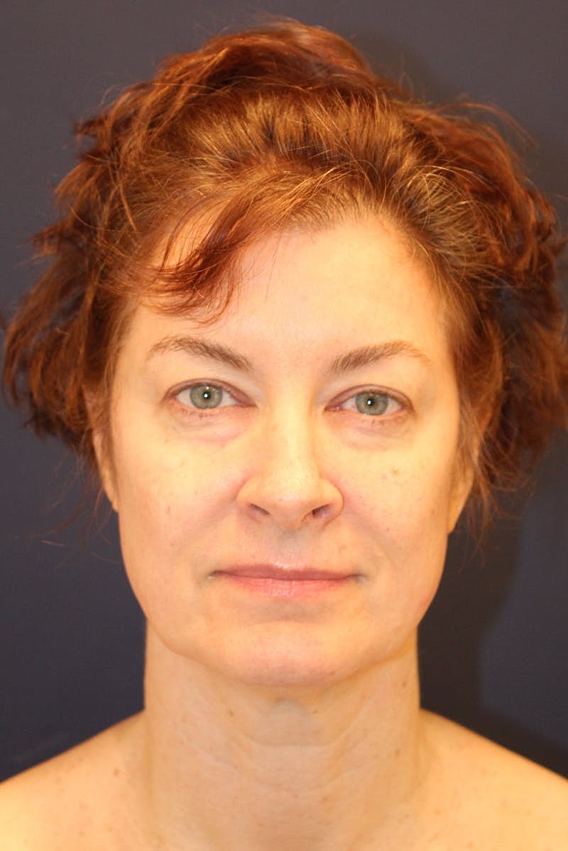 Neck Lift Before & After