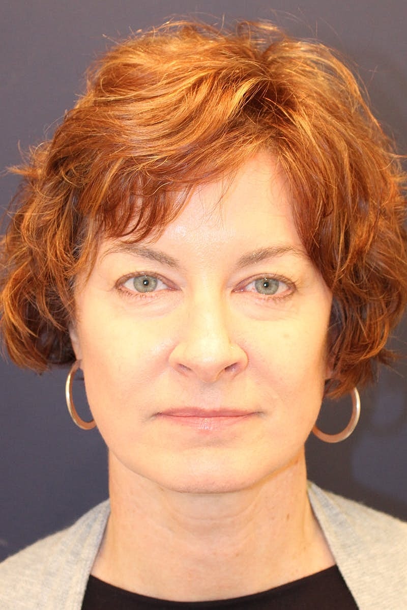 Neck Lift Before & After