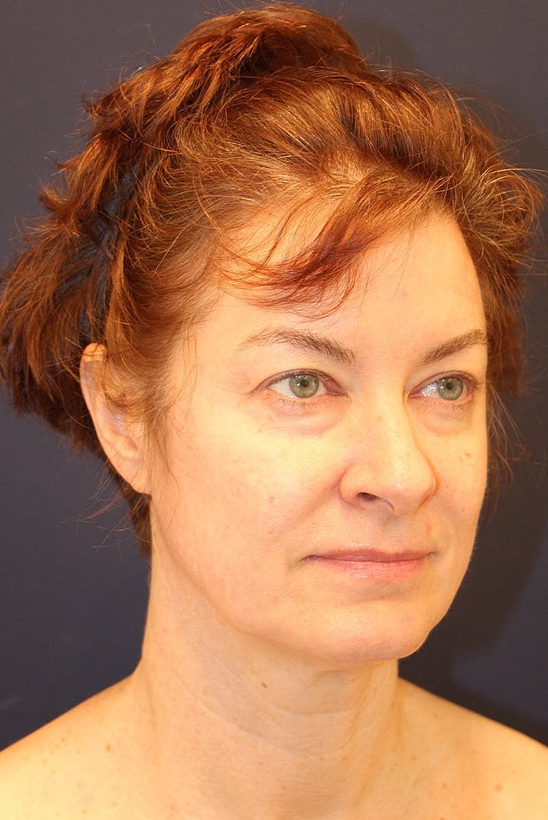 Neck Lift Before & After