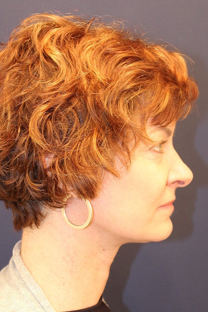 Neck Lift Before & After